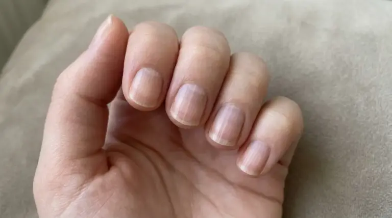 Primo piano di una mano con unghie naturali che mostrano evidenti righe verticali sulla superficie