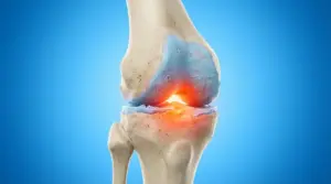 Illustrazione medica del ginocchio con cartilagine consumata e area infiammata nell’articolazione