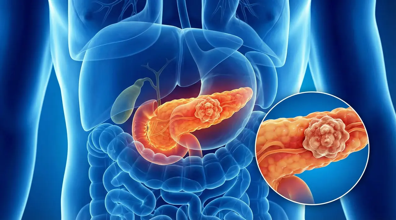 Illustrazione medica del pancreas con massa tumorale evidenziata nell’addome